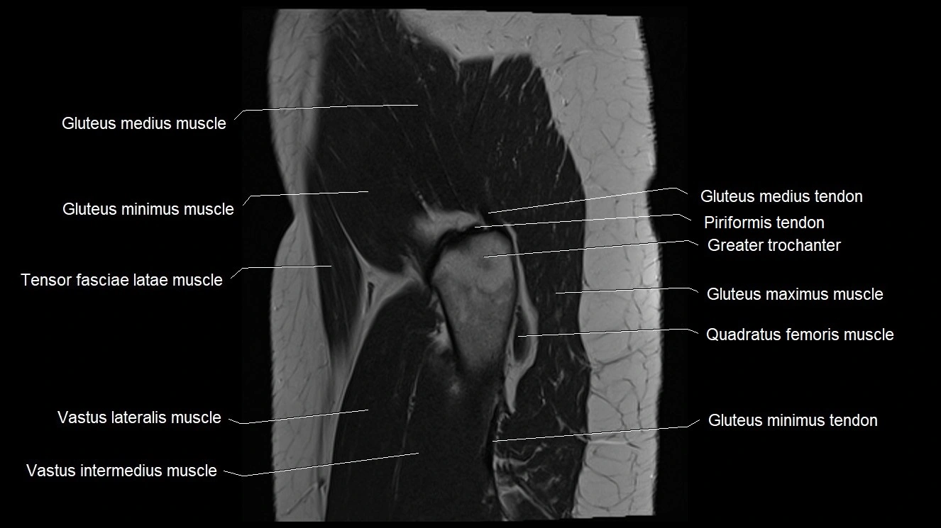 Hip sagittal cross sectional anatomy image 8.webp